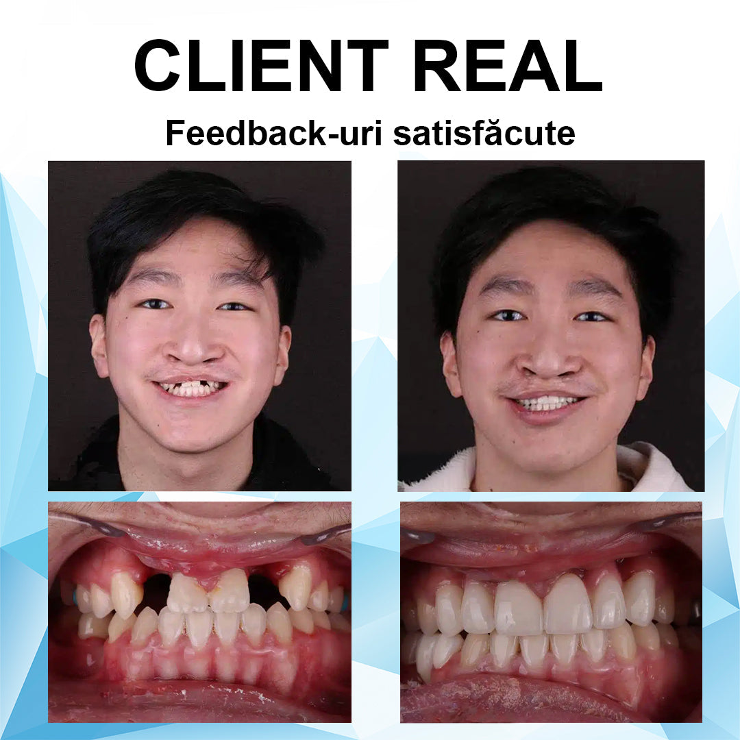 👍 [ADA Recomandările] 🌿🦷𝗦𝗺𝗶𝗹𝗲𝗵𝗽𝘆™ Set de proteze cu reline din silicon