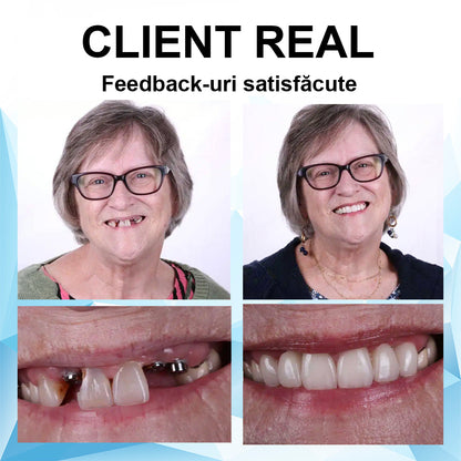 👍 [ADA Recomandările] 🌿🦷𝗦𝗺𝗶𝗹𝗲𝗵𝗽𝘆™ Set de proteze cu reline din silicon