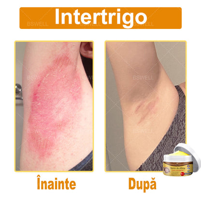 BSWELL® venin de albine cuprinzătoare cremă 🌿 Aprobat și recomandat de AAD