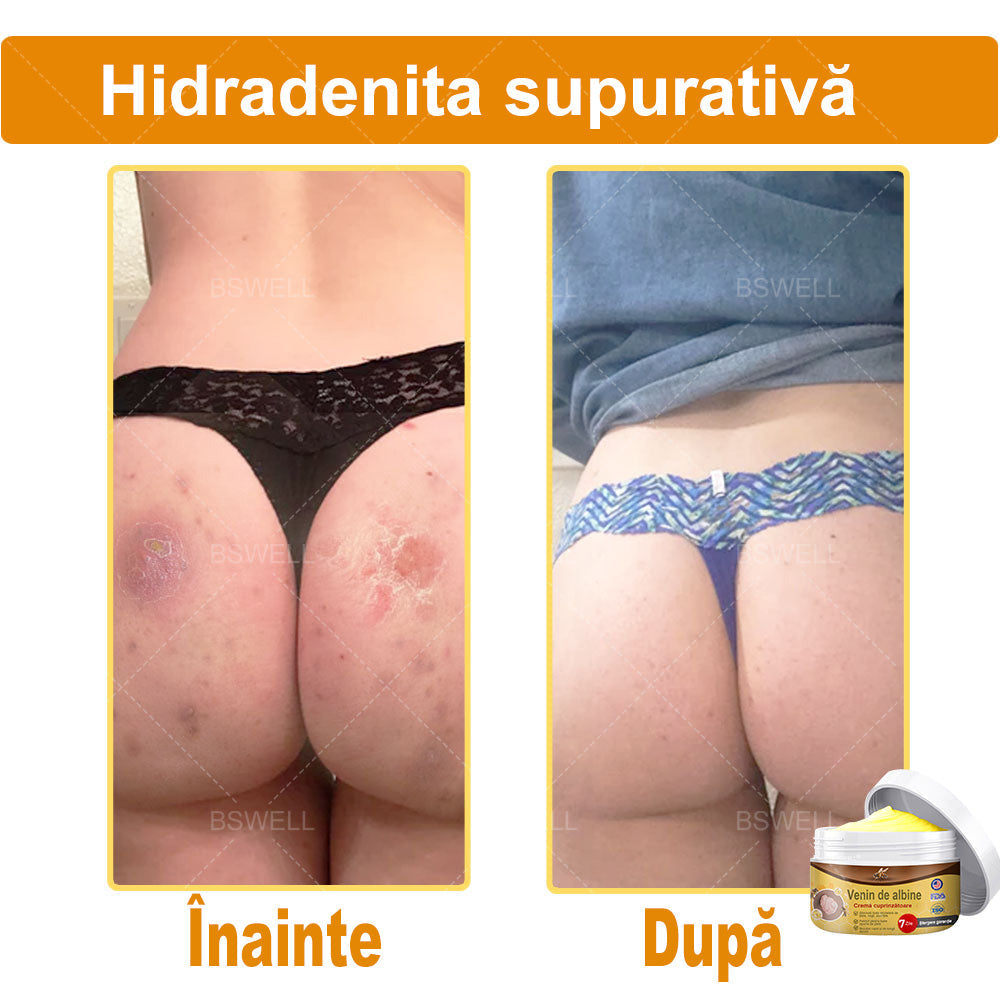 BSWELL® venin de albine cuprinzătoare cremă 🌿 Aprobat și recomandat de AAD