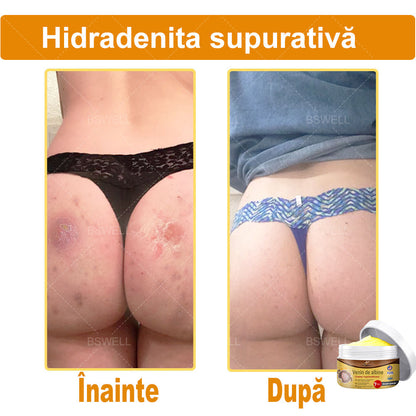 BSWELL® venin de albine cuprinzătoare cremă 🌿 Aprobat și recomandat de AAD