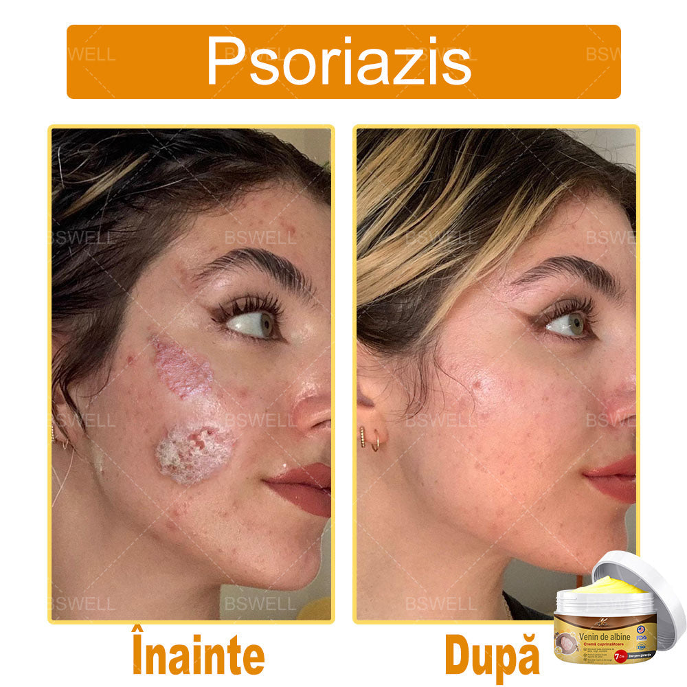 BSWELL® venin de albine cuprinzătoare cremă 🌿 Aprobat și recomandat de AAD